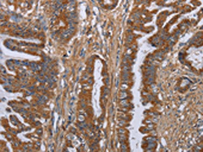 The image on the left is immunohistochemistry of paraffin-embedded Human esophagus cancer tissue using CSB-PA781691(LUM Antibody) at dilution 1/40, on the right is treated with fusion protein. (Original magnification: ×200)