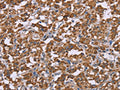 The image on the left is immunohistochemistry of paraffin-embedded Human thyroid cancer tissue using CSB-PA781876(PPIF Antibody) at dilution 1/45, on the right is treated with fusion protein. (Original magnification: ×200)