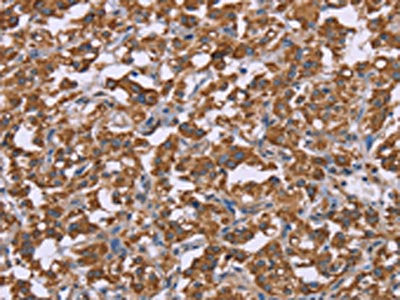 The image on the left is immunohistochemistry of paraffin-embedded Human thyroid cancer tissue using CSB-PA781876(PPIF Antibody) at dilution 1/45, on the right is treated with fusion protein. (Original magnification: ×200)