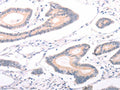 The image on the left is immunohistochemistry of paraffin-embedded Human colon cancer tissue using CSB-PA781903(ABCF3 Antibody) at dilution 1/30, on the right is treated with fusion protein. (Original magnification: ×200)