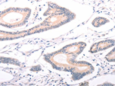 The image on the left is immunohistochemistry of paraffin-embedded Human colon cancer tissue using CSB-PA781903(ABCF3 Antibody) at dilution 1/30, on the right is treated with fusion protein. (Original magnification: ×200)