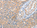 The image on the left is immunohistochemistry of paraffin-embedded Human cervical cancer tissue using CSB-PA782295(ACOT8 Antibody) at dilution 1/15, on the right is treated with fusion protein. (Original magnification: ×200)