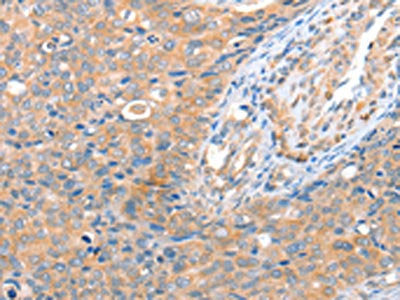 The image on the left is immunohistochemistry of paraffin-embedded Human cervical cancer tissue using CSB-PA782295(ACOT8 Antibody) at dilution 1/15, on the right is treated with fusion protein. (Original magnification: ×200)