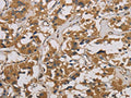 The image is immunohistochemistry of paraffin-embedded Human thyroid cancer tissue using CSB-PA782311(CORO1C Antibody) at dilution 1/50. (Original magnification: ×200)