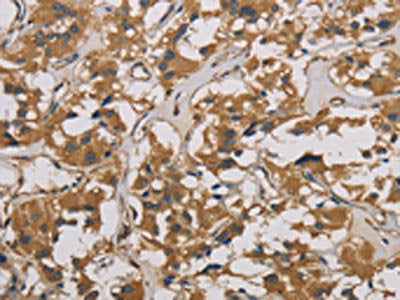The image is immunohistochemistry of paraffin-embedded Human thyroid cancer tissue using CSB-PA782311(CORO1C Antibody) at dilution 1/50. (Original magnification: ×200)