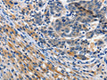 The image on the left is immunohistochemistry of paraffin-embedded Human liver cancer tissue using CSB-PA782639(ITGAX Antibody) at dilution 1/15, on the right is treated with synthetic peptide. (Original magnification: ×200)