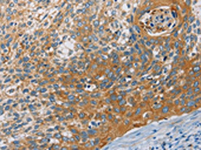 The image on the left is immunohistochemistry of paraffin-embedded Human cervical cancer tissue using CSB-PA782845(KCNMA1 Antibody) at dilution 1/30, on the right is treated with fusion protein. (Original magnification: ×200)