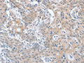 The image on the left is immunohistochemistry of paraffin-embedded Human gastic cancer tissue using CSB-PA782907(PAPSS1 Antibody) at dilution 1/40, on the right is treated with fusion protein. (Original magnification: ×200)