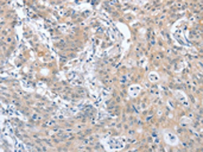 The image on the left is immunohistochemistry of paraffin-embedded Human gastic cancer tissue using CSB-PA782907(PAPSS1 Antibody) at dilution 1/40, on the right is treated with fusion protein. (Original magnification: ×200)
