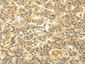 The image on the left is immunohistochemistry of paraffin-embedded Human liver cancer tissue using CSB-PA783286(CAMK1G Antibody) at dilution 1/20, on the right is treated with fusion protein. (Original magnification: ×200)