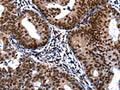 The image on the left is immunohistochemistry of paraffin-embedded Human cervical cancer tissue using CSB-PA783338(DFFA Antibody) at dilution 1/20, on the right is treated with fusion protein. (Original magnification: ×200)