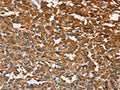 The image on the left is immunohistochemistry of paraffin-embedded Human thyroid cancer tissue using CSB-PA783807(ATP1B2 Antibody) at dilution 1/30, on the right is treated with fusion protein. (Original magnification: ×200)