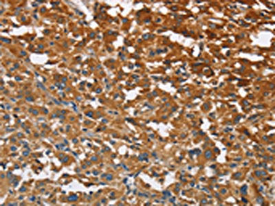 The image on the left is immunohistochemistry of paraffin-embedded Human thyroid cancer tissue using CSB-PA783807(ATP1B2 Antibody) at dilution 1/30, on the right is treated with fusion protein. (Original magnification: ×200)