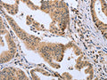 The image on the left is immunohistochemistry of paraffin-embedded Human gastic cancer tissue using CSB-PA783949(DLD Antibody) at dilution 1/20, on the right is treated with fusion protein. (Original magnification: ×200)