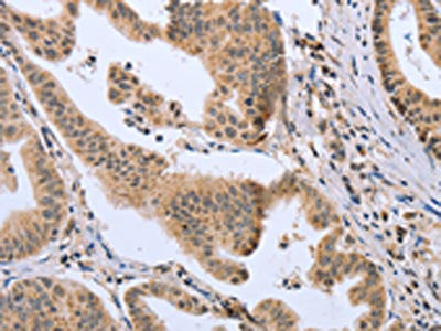 The image on the left is immunohistochemistry of paraffin-embedded Human gastic cancer tissue using CSB-PA783949(DLD Antibody) at dilution 1/20, on the right is treated with fusion protein. (Original magnification: ×200)