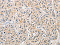 The image on the left is immunohistochemistry of paraffin-embedded Human liver cancer tissue using CSB-PA784037(APLF Antibody) at dilution 1/20, on the right is treated with fusion protein. (Original magnification: ×200)