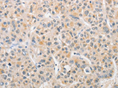 The image on the left is immunohistochemistry of paraffin-embedded Human liver cancer tissue using CSB-PA784037(APLF Antibody) at dilution 1/20, on the right is treated with fusion protein. (Original magnification: ×200)