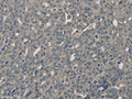 The image on the left is immunohistochemistry of paraffin-embedded Human ovarian cancer tissue using CSB-PA784177(EDN1 Antibody) at dilution 1/30, on the right is treated with fusion protein. (Original magnification: ×200)