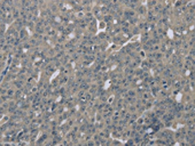 The image on the left is immunohistochemistry of paraffin-embedded Human ovarian cancer tissue using CSB-PA784177(EDN1 Antibody) at dilution 1/30, on the right is treated with fusion protein. (Original magnification: ×200)