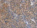 The image on the left is immunohistochemistry of paraffin-embedded Human liver cancer tissue using CSB-PA784556(MAP3K13 Antibody) at dilution 1/40, on the right is treated with fusion protein. (Original magnification: ×200)