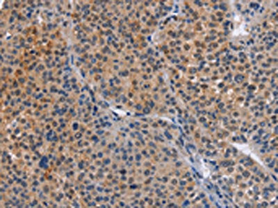 The image on the left is immunohistochemistry of paraffin-embedded Human liver cancer tissue using CSB-PA784556(MAP3K13 Antibody) at dilution 1/40, on the right is treated with fusion protein. (Original magnification: ×200)
