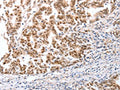 The image on the left is immunohistochemistry of paraffin-embedded Human gastic cancer tissue using CSB-PA784650(CTBP2 Antibody) at dilution 1/25, on the right is treated with fusion protein. (Original magnification: ×200)