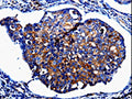 The image on the left is immunohistochemistry of paraffin-embedded Human breast cancer tissue using CSB-PA784664(IL10RB Antibody) at dilution 1/60, on the right is treated with fusion protein. (Original magnification: ×200)