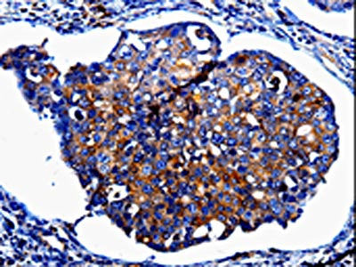 The image on the left is immunohistochemistry of paraffin-embedded Human breast cancer tissue using CSB-PA784664(IL10RB Antibody) at dilution 1/60, on the right is treated with fusion protein. (Original magnification: ×200)