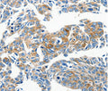 Immunohistochemical analysis of paraffin-embedded Human lung cancer tissue using at dilution 1/50.