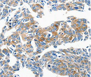 Immunohistochemical analysis of paraffin-embedded Human lung cancer tissue using at dilution 1/50.