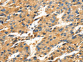 The image on the left is immunohistochemistry of paraffin-embedded Human liver cancer tissue using CSB-PA785325(SPARC Antibody) at dilution 1/25, on the right is treated with fusion protein. (Original magnification: ×200)