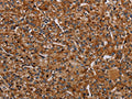 The image on the left is immunohistochemistry of paraffin-embedded Human prostate cancer tissue using CSB-PA785454(NDUFA8 Antibody) at dilution 1/40, on the right is treated with synthetic peptide. (Original magnification: ×200)