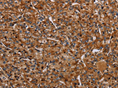 The image on the left is immunohistochemistry of paraffin-embedded Human prostate cancer tissue using CSB-PA785454(NDUFA8 Antibody) at dilution 1/40, on the right is treated with synthetic peptide. (Original magnification: ×200)