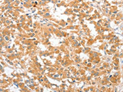 The image on the left is immunohistochemistry of paraffin-embedded Human thyroid cancer tissue using CSB-PA785654(COL4A3BP Antibody) at dilution 1/60, on the right is treated with fusion protein. (Original magnification: ×200)