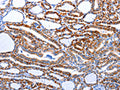 The image on the left is immunohistochemistry of paraffin-embedded Human thyroid cancer tissue using CSB-PA786000(CASP3 (active) Antibody) at dilution 1/15, on the right is treated with synthetic peptide. (Original magnification: ×200)