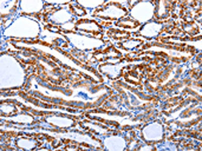 The image on the left is immunohistochemistry of paraffin-embedded Human thyroid cancer tissue using CSB-PA786000(CASP3 (active) Antibody) at dilution 1/15, on the right is treated with synthetic peptide. (Original magnification: ×200)