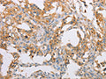 The image on the left is immunohistochemistry of paraffin-embedded Human thyroid cancer tissue using CSB-PA786075(ACTR2 Antibody) at dilution 1/40, on the right is treated with fusion protein. (Original magnification: ×200)