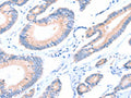 The image on the left is immunohistochemistry of paraffin-embedded Human colon cancer tissue using CSB-PA786632(AADACL2 Antibody) at dilution 1/25, on the right is treated with fusion protein. (Original magnification: ×200)
