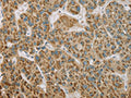 The image on the left is immunohistochemistry of paraffin-embedded Human liver cancer tissue using CSB-PA787197(EHHADH Antibody) at dilution 1/20, on the right is treated with fusion protein. (Original magnification: ×200)