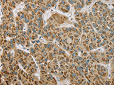 The image on the left is immunohistochemistry of paraffin-embedded Human liver cancer tissue using CSB-PA787197(EHHADH Antibody) at dilution 1/20, on the right is treated with fusion protein. (Original magnification: ×200)