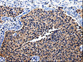 The image on the left is immunohistochemistry of paraffin-embedded Human renal cancer tissue using CSB-PA787438(BID Antibody) at dilution 1/25, on the right is treated with fusion protein. (Original magnification: ×200)
