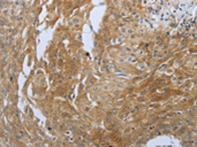 The image on the left is immunohistochemistry of paraffin-embedded Human cervical cancer tissue using CSB-PA787439(SHBG Antibody) at dilution 1/20, on the right is treated with synthetic peptide. (Original magnification: ×200)