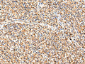 The image on the left is immunohistochemistry of paraffin-embedded Human prostate cancer tissue using CSB-PA787474(ADAMTS1 Antibody) at dilution 1/35, on the right is treated with synthetic peptide. (Original magnification: ×200)