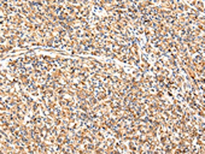 The image on the left is immunohistochemistry of paraffin-embedded Human prostate cancer tissue using CSB-PA787474(ADAMTS1 Antibody) at dilution 1/35, on the right is treated with synthetic peptide. (Original magnification: ×200)