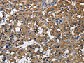 The image on the left is immunohistochemistry of paraffin-embedded Human thyroid cancer tissue using CSB-PA787597(CD160 Antibody) at dilution 1/30, on the right is treated with fusion protein. (Original magnification: ×200)