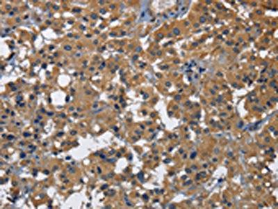 The image on the left is immunohistochemistry of paraffin-embedded Human thyroid cancer tissue using CSB-PA787597(CD160 Antibody) at dilution 1/30, on the right is treated with fusion protein. (Original magnification: ×200)