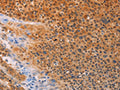 The image on the left is immunohistochemistry of paraffin-embedded Human liver cancer tissue using CSB-PA787644(ADHFE1 Antibody) at dilution 1/30, on the right is treated with synthetic peptide. (Original magnification: ×200)