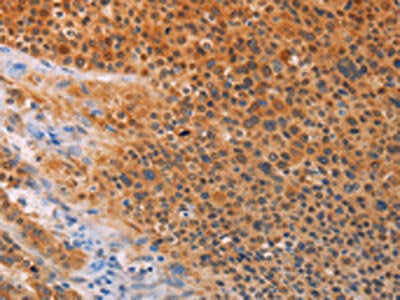 The image on the left is immunohistochemistry of paraffin-embedded Human liver cancer tissue using CSB-PA787644(ADHFE1 Antibody) at dilution 1/30, on the right is treated with synthetic peptide. (Original magnification: ×200)