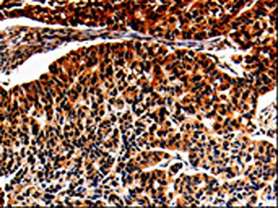 The image is immunohistochemistry of paraffin-embedded Human lung cancer tissue using CSB-PA787659(ALOX5 Antibody) at dilution 1/25. (Original magnification: ×200)