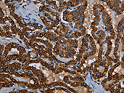 The image on the left is immunohistochemistry of paraffin-embedded Human thyroid cancer tissue using CSB-PA787705(PIDD1 Antibody) at dilution 1/50, on the right is treated with fusion protein. (Original magnification: ×200)